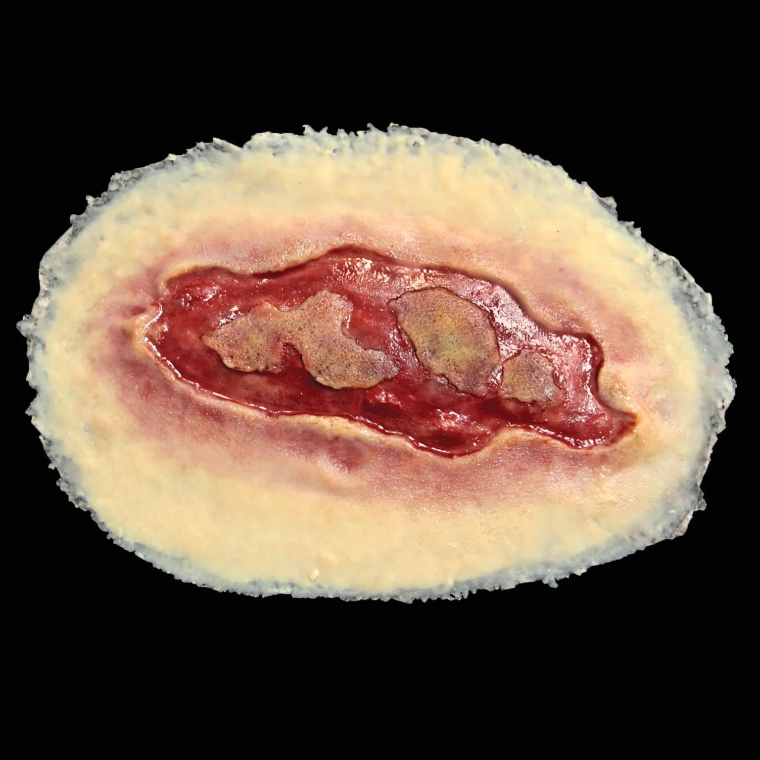 severe-electrical-burn-wound-prosthetic.jpg Electrical Burn, Large - Image 1