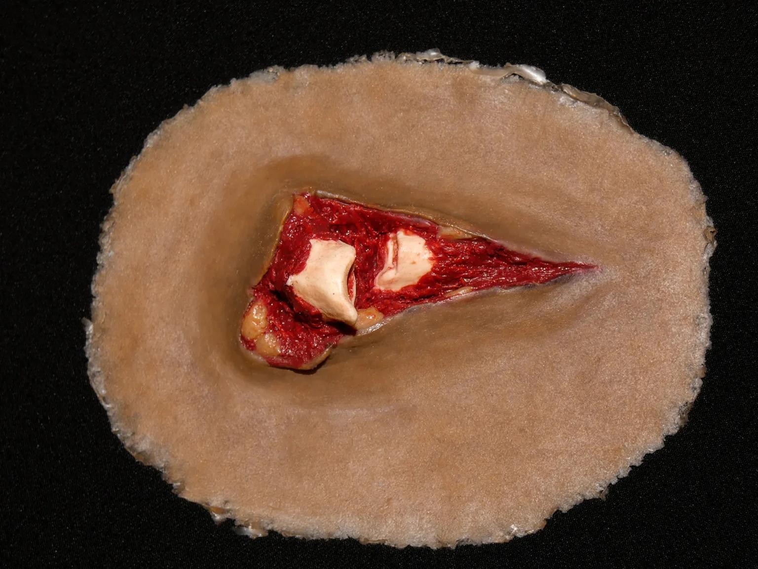 fracture-simulation.jpg Fracture Wound - Image 1