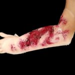 Third-Degree Arm Burn