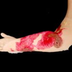 Third-Degree Arm Burn (Debrided)