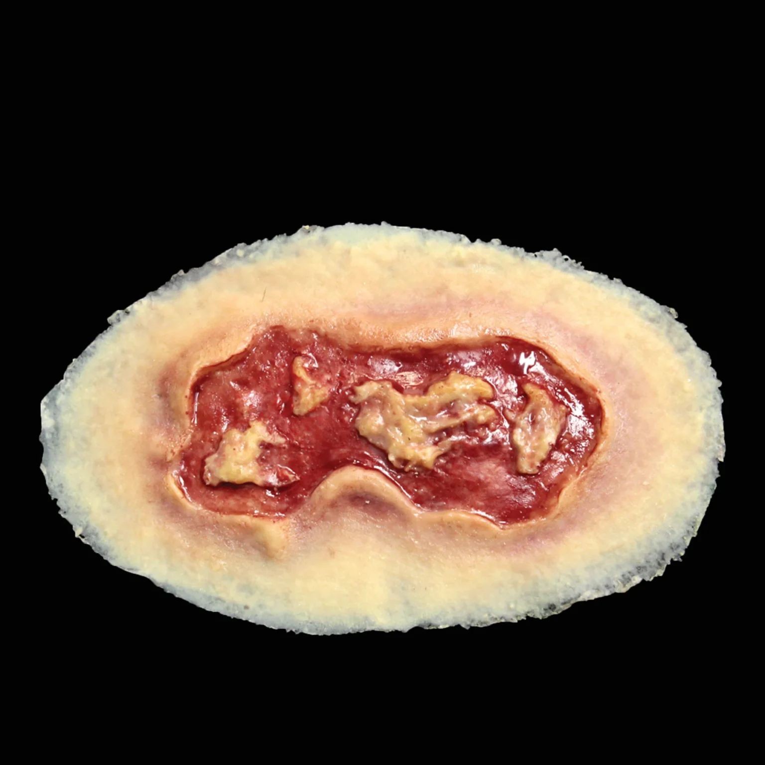 medium-electrical-burn-wound-simulation.jpg Electrical Burn, Medium - Image 1