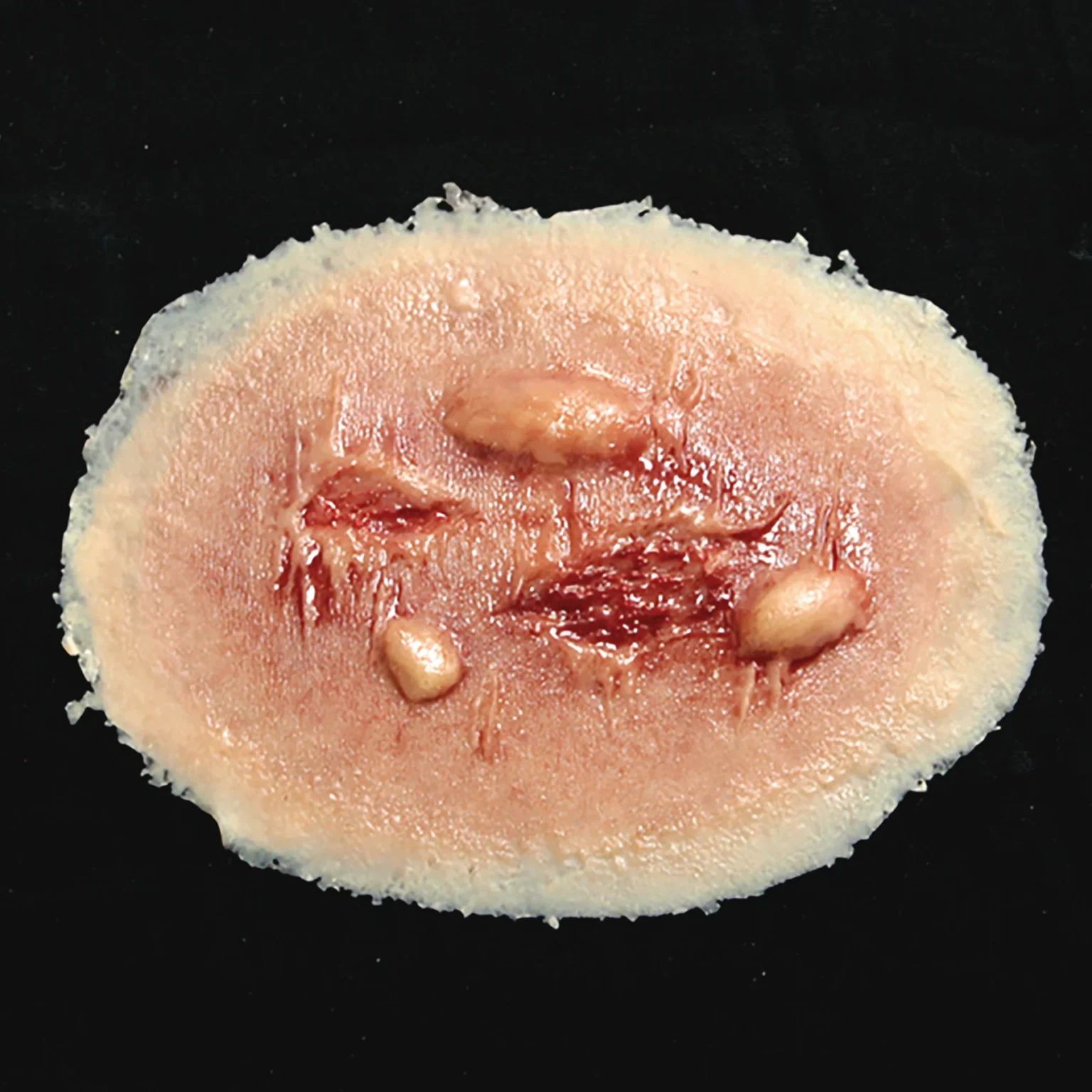 moderate-thermal-burn-prosthetic.jpg Thermal Burn, Medium - Image 1